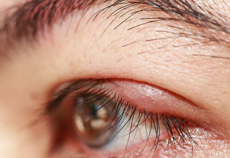 Vuotavat silmä voivat johtua Meibomin rauhasten toimintahäiriöstä